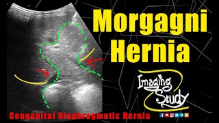 Morgagni Hernia  Congenital Diaphragmatic Hernia  Ultrasound  Case 270 [upl. by Evilc740]