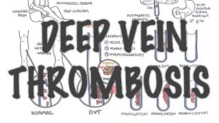 Deep Vein Thrombosis  Overview pathophysiology treatment complications [upl. by Thursby764]