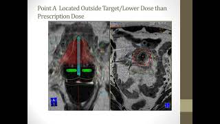 MRIbased brachytherapy for cervical cancer Lecture [upl. by Matthias573]