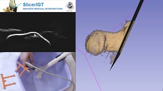 Realtime 3D ultrasound reconstruction using 3D Slicer  SlicerIGT [upl. by Ovatsug]