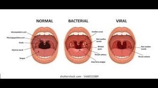 Pharyngitis Part 1 Viral Pharyngitis [upl. by Oleic]