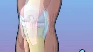 PreOp® Anterior Cruciate Ligament Patient Education [upl. by Nuncia]