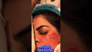 Micro Needling Treatment  Dermatologist  Rehman Skin Care Clinic  Islamabad  Blue Area skincare [upl. by Ashia413]