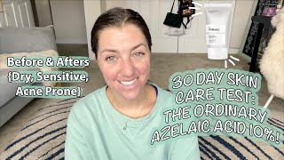 30 DAY SKIN CARE TEST THE ORDINARY AZELAIC ACID 10 Before amp Afters Dry Sensitive Acne Prone [upl. by Leatri105]