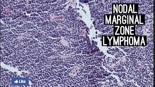 Nodal Marginal Zone Lymphoma [upl. by Johna502]