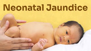 ABO incompatibility leading to neonatal jaundice neonataljaundice ABOincompatibility paediatrics [upl. by Elacsap]