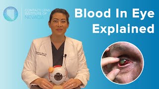 Subconjunctival Hemorrhage Blood In Eye Explained Causes amp Treatments [upl. by Aikcin]