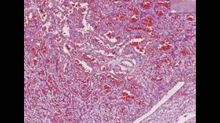 Histopathology Kidney Renal cell carcinoma [upl. by Llednek]