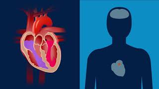 Was ist Vorhofflimmern  Erklärfilm  Medtronic [upl. by Enoch]