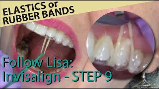 🦷 Follow Lisa Invisalign 9  Gap in tray and placement of elastic bands [upl. by Aihsele]