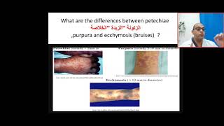 How can I differentiate between petechiae purpura and eecymosis bruises  platelet coagulation [upl. by Grussing]