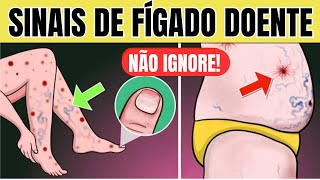 10 SINAIS de PROBLEMA no FÍGADO na PELE  Sintomas de GORDURA NO FÍGADO CIRROSE e HEPATITE [upl. by Dinin762]