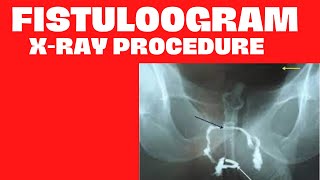 Xray Procedure Fistulogram  Xray procedure Fistulogram Test in Radiology In Urdu Hindi [upl. by Whittaker]