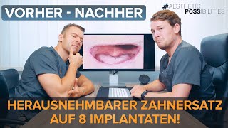 Von zahnlos auf quotfeste Zähnequot mit insgesamt 8 Implantaten amp gaumenfreier herausnehmbarer Prothese [upl. by Azeria]