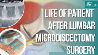 Life of Patient after Lumbar Microdiscectomy Surgery  Recovery Post OP Complete Info in English [upl. by Andee944]