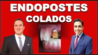 ENDOPOSTES METÁLICOS VACIADOS O COLADOS POSTES DE ENDODONCIA [upl. by Nas]