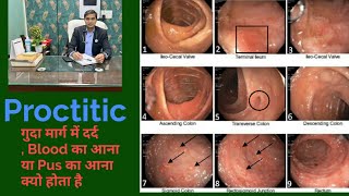 Proctitis Pain in Rectum Chrons Disease  ulcerative Colitis Dr Sanjeet Sahu [upl. by Otsirc]