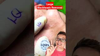 CRAZY BLACKHEAD REMOVAL  Huge Blackheads On Nose shorts [upl. by Portie]