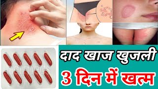 भयंकर से भयंकर खुजली मात्र 3 दिन में खत्मItching treatment दाद खाज खुजली चर्म रोग से छुटकारा [upl. by Alick]