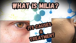 What Is Milia What Are Its Causes And Its Treatment [upl. by Nagam715]