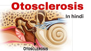 Otosclerosis nursing lecture in hindi  causetype symptoms treatmentsurgery  otosclerosis ent [upl. by Enrobso456]