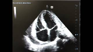 Septal bounce Constrictive Pericarditis [upl. by Tenom]