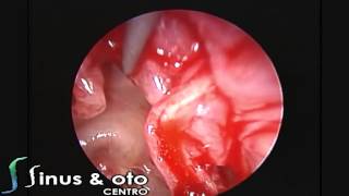 Endoscopic Cartilage Tympanoplasty [upl. by Grube590]