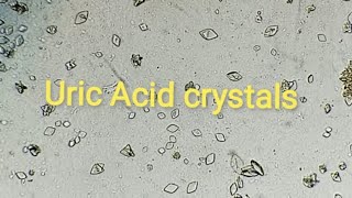 Uric Acid crystals in urine sample GUE urineanalysis urinalysis crystals [upl. by Brandenburg]