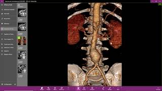 Aneurisma da aorta abdominal [upl. by Filbert456]