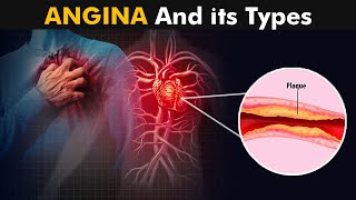 What is Angina And How it Works  Types Causes Symptoms and treatment 3D Animation [upl. by Bergstrom365]