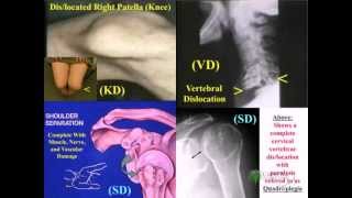 Knee Disarticulation [upl. by Nikola]