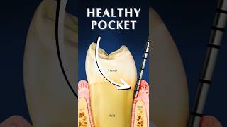 What Is A Gingival Pocket [upl. by Ayihsa769]