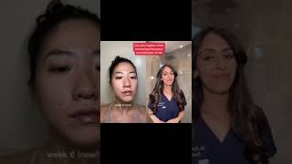 TRETINOIN journey for glass skin What to expect  Dr Adel shorts [upl. by Lanti]