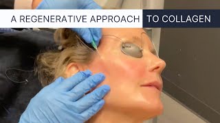 PDO Thread Lift the Ultimate NonSurgical Facelift [upl. by Catt265]