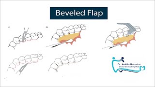 BEVELED FLAP PERIODONTAL FLAP SURGERY ON PALATAL ASPECT MODIFICATION OF APICALLY REPOSITIONED FLAP [upl. by Kipp]