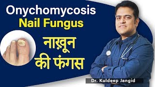 Onychomycosis  Nail Fungus Treatment  नाखून की फंगस का ट्रीटमेंट  TInea Unguium Treatment [upl. by Devonna]