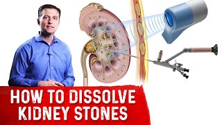 How To Dissolve Kidney Stones Explained By DrBerg [upl. by Reinal754]