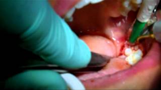 Estrazione dente giudizio incluso con piezo surgery Dr Floriano Petrone [upl. by Llenol822]