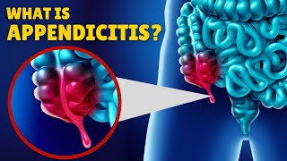 Appendicitis – Causes Signs and Symptoms Diagnosis amp Treatment [upl. by Orvan544]