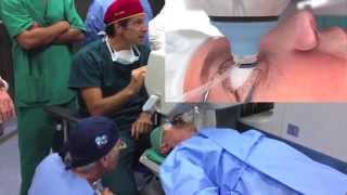 Cataratta con LenSx laser  Dr Luca Gualdi Rome  Italy [upl. by Ynohta]