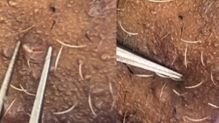 Tweezing chin hair 13💛🩷hirsutism chin pluckingwhitehair removal [upl. by Samala379]