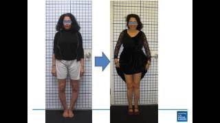 Dr Robert Rozbruch  Bowleg Correction [upl. by Essila]