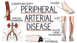 Understanding Peripheral Arterial Disease [upl. by Lamberto]