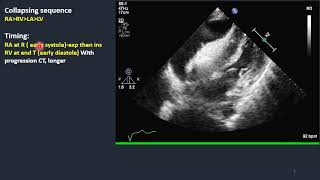 Cardiac Tamponade Part4 Chamber collapsing [upl. by Nomzaj]