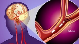 Stroke Prevention amp Transient Ischemic Attack TIA [upl. by Echo]