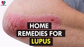 Home Remedies for Lupus  Health Sutra [upl. by Artus]