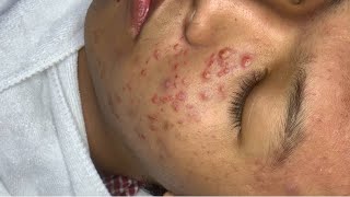 Blackheads Removal Acne Treatment Pimple Popping 17 [upl. by Valda749]