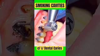 SMOKING DENTAL CAVITIES [upl. by Nayb366]