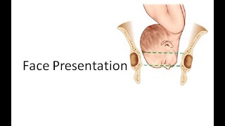 Obstetrics 471 Face Presentation ROP LMA MentoAnterior MentoPosterior Flanks not full No Moulding [upl. by Eniamej689]