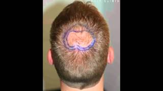 Haartransplantation FUE 1500 Tonsur [upl. by Akeme]